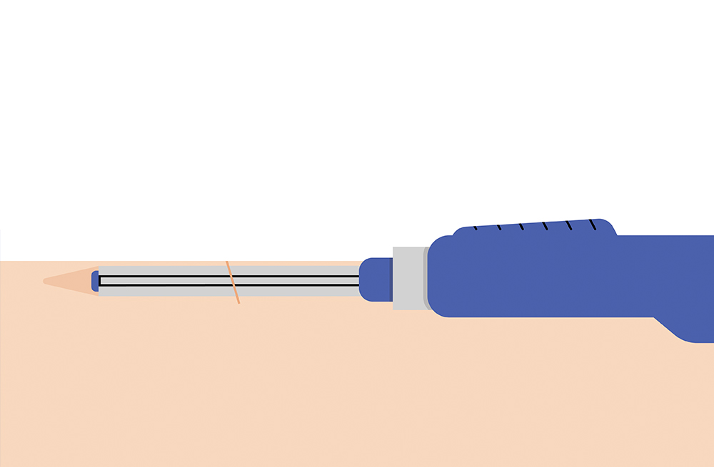 Step two of the insertion process for a wearable glucose monitor. 